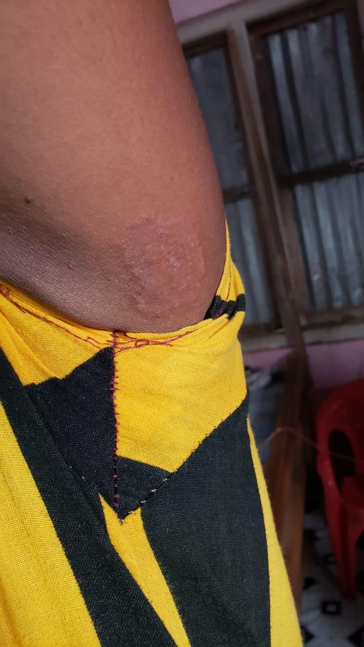 Epedemic skin disease attacks Mahendraganj area of Garo Hills