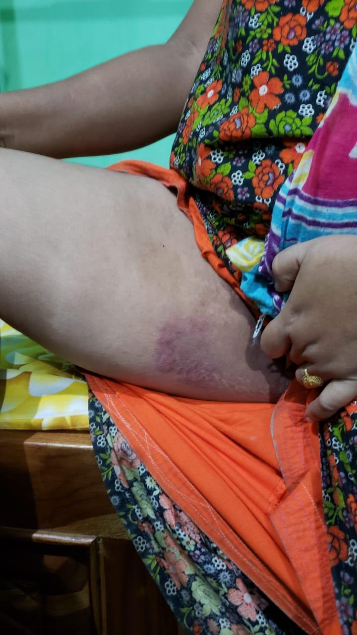 Epedemic skin disease attacks Mahendraganj area of Garo Hills