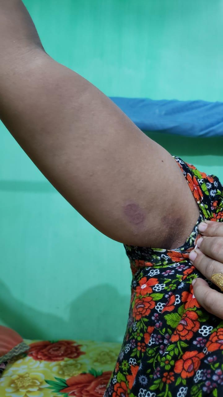Epedemic skin disease attacks Mahendraganj area of Garo Hills