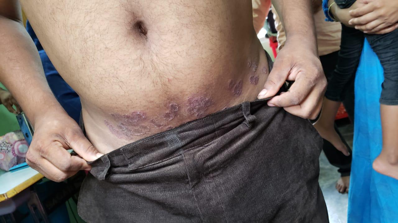 Epedemic skin disease attacks Mahendraganj area of Garo Hills