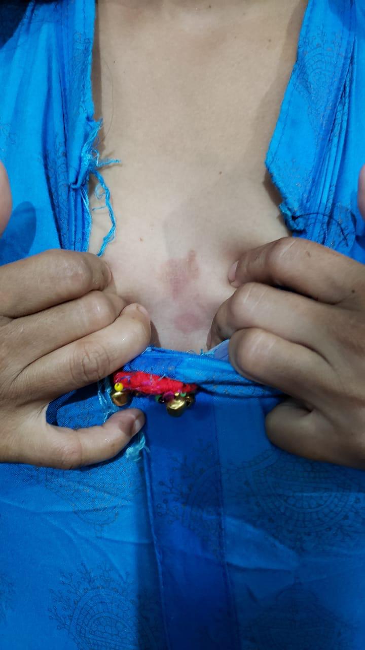 Epedemic skin disease attacks Mahendraganj area of Garo Hills