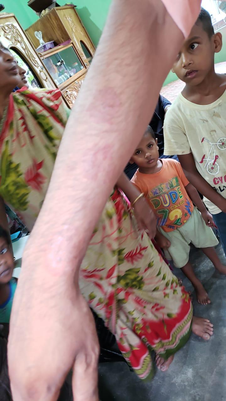 Epedemic skin disease attacks Mahendraganj area of Garo Hills