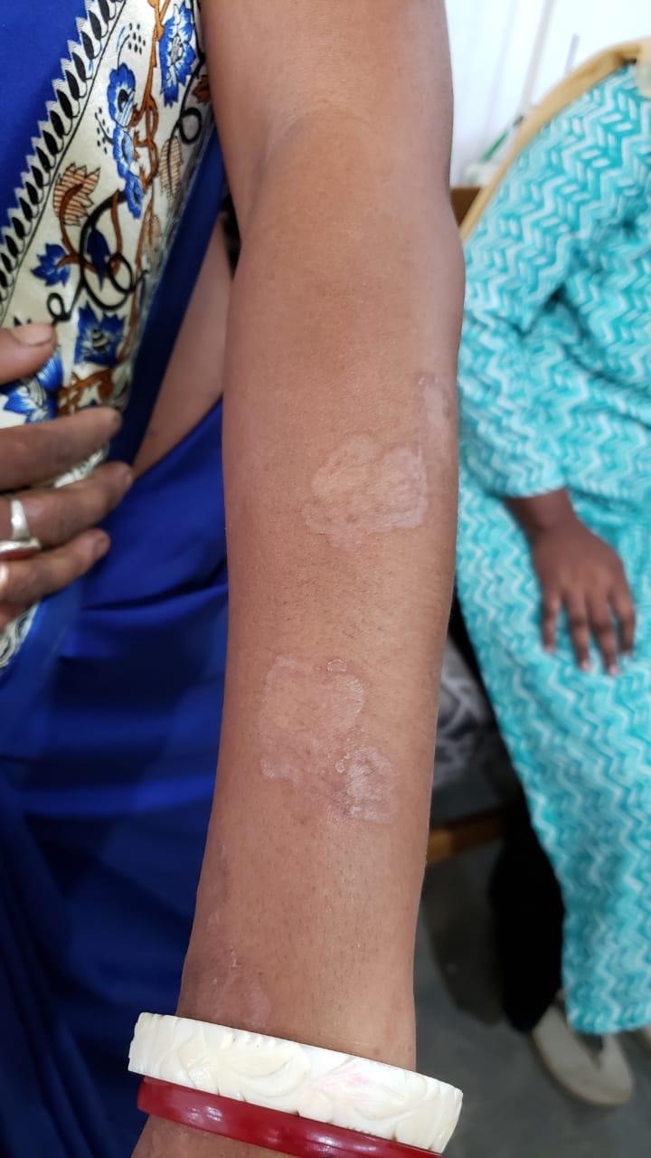 Epedemic skin disease attacks Mahendraganj area of Garo Hills
