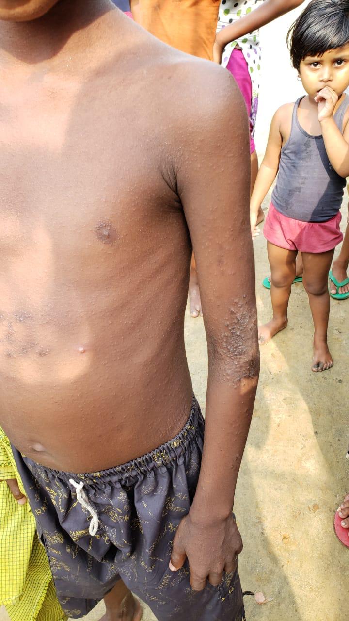 Epedemic skin disease attacks Mahendraganj area of Garo Hills
