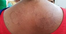 Epedemic skin disease attacks Mahendraganj area of Garo Hills