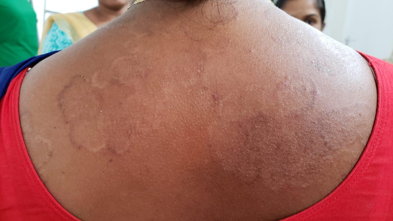 Epedemic skin disease attacks Mahendraganj area of Garo Hills